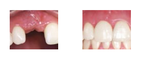 Before and After Implant