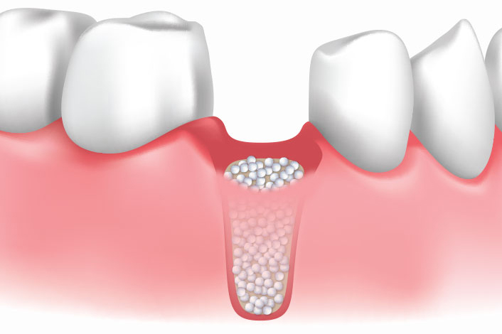 Bone Grafting