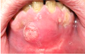 A non healing ulcer