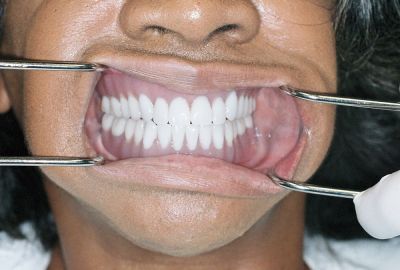 Beautiful Smile with Implants