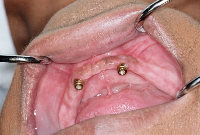 Implant Photo