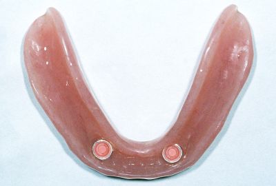 Implant Photo