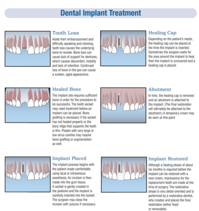 Dental Implant Treatment