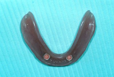 Implant Photo