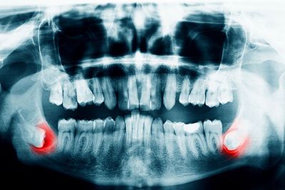 X-ray of wisdom teeth